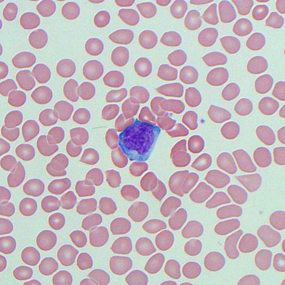 atypical lymphocyte ebv