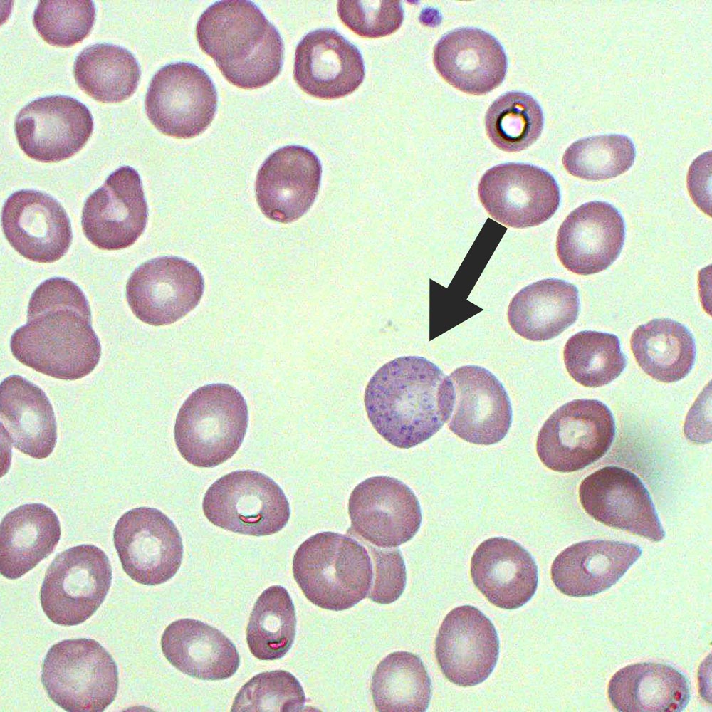 Pathology Outlines - Megaloblastic anemia