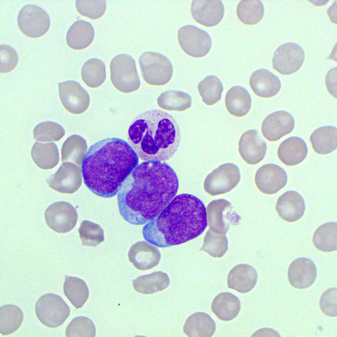 circulating-blasts-blood-film-medschool