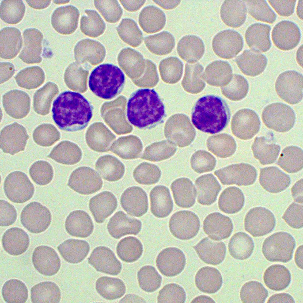 Lymphocytes Blood Film MedSchool