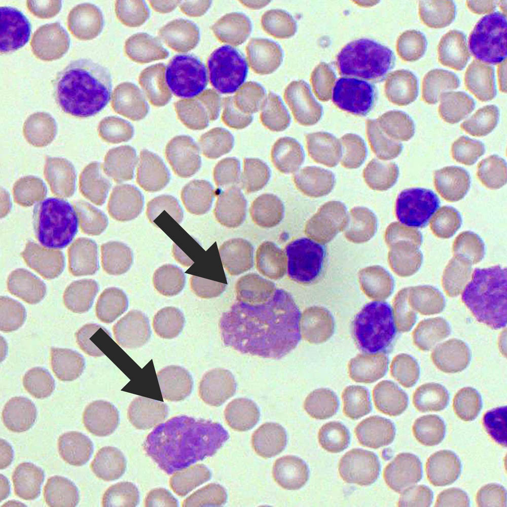 Smudge Cells Blood Film MedSchool