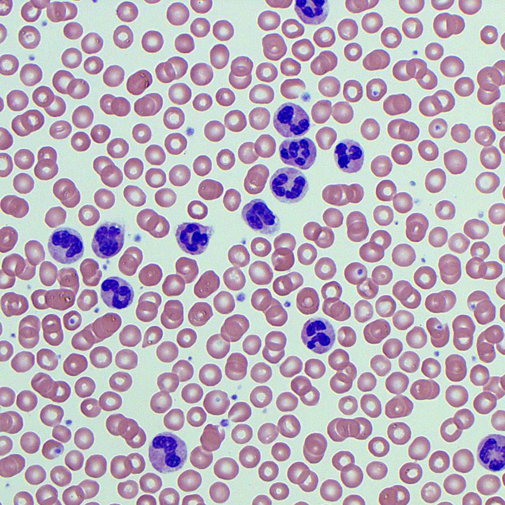 neutrophils-blood-film-medschool