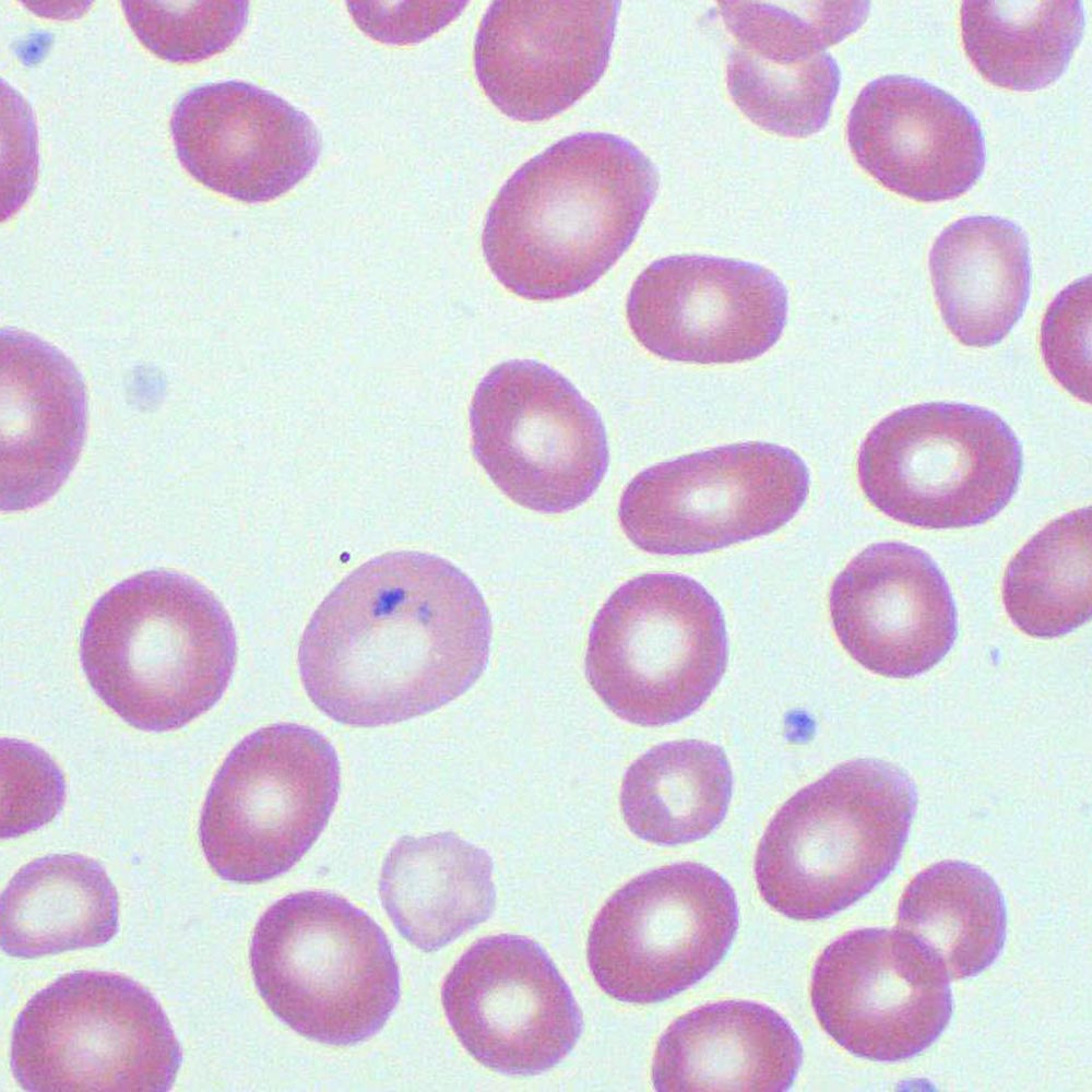 Medical Laboratory Technologists Pakistan - Red Blood Cell Irregularities:  SIZE Anisocytosis: this is a variation in size of RBCs; it may be an  indication of anemia Macrocytosis: large RBCs that may be