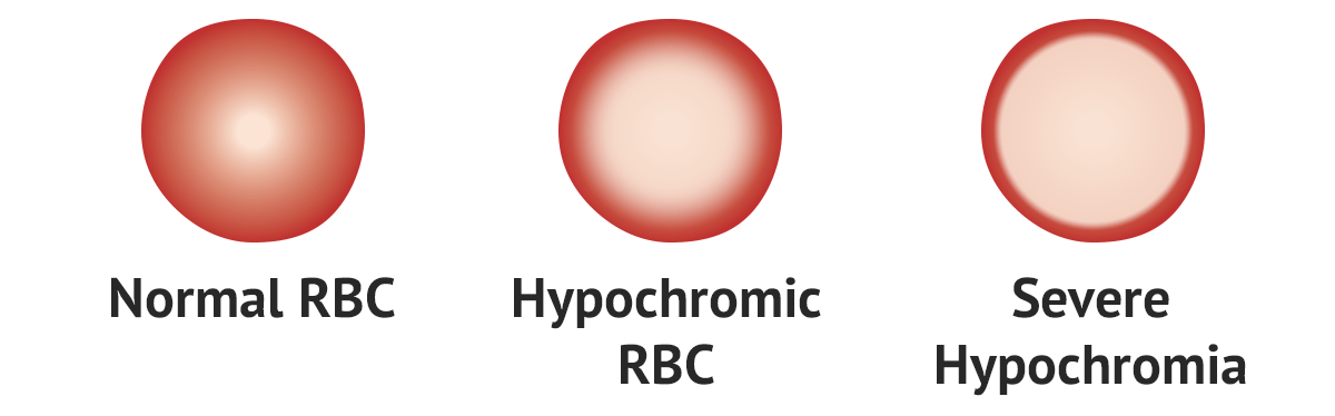 Hypochromia Test Findings MedSchool