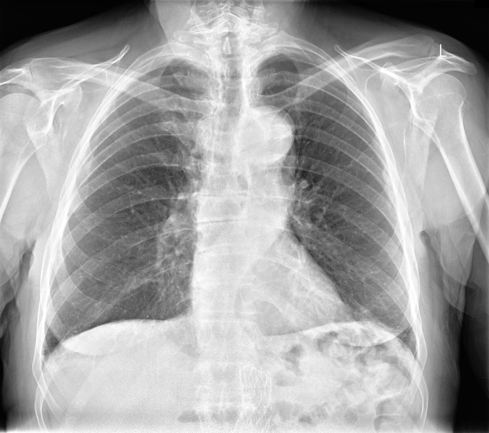 Aortic Tortuosity Test Findings MedSchool