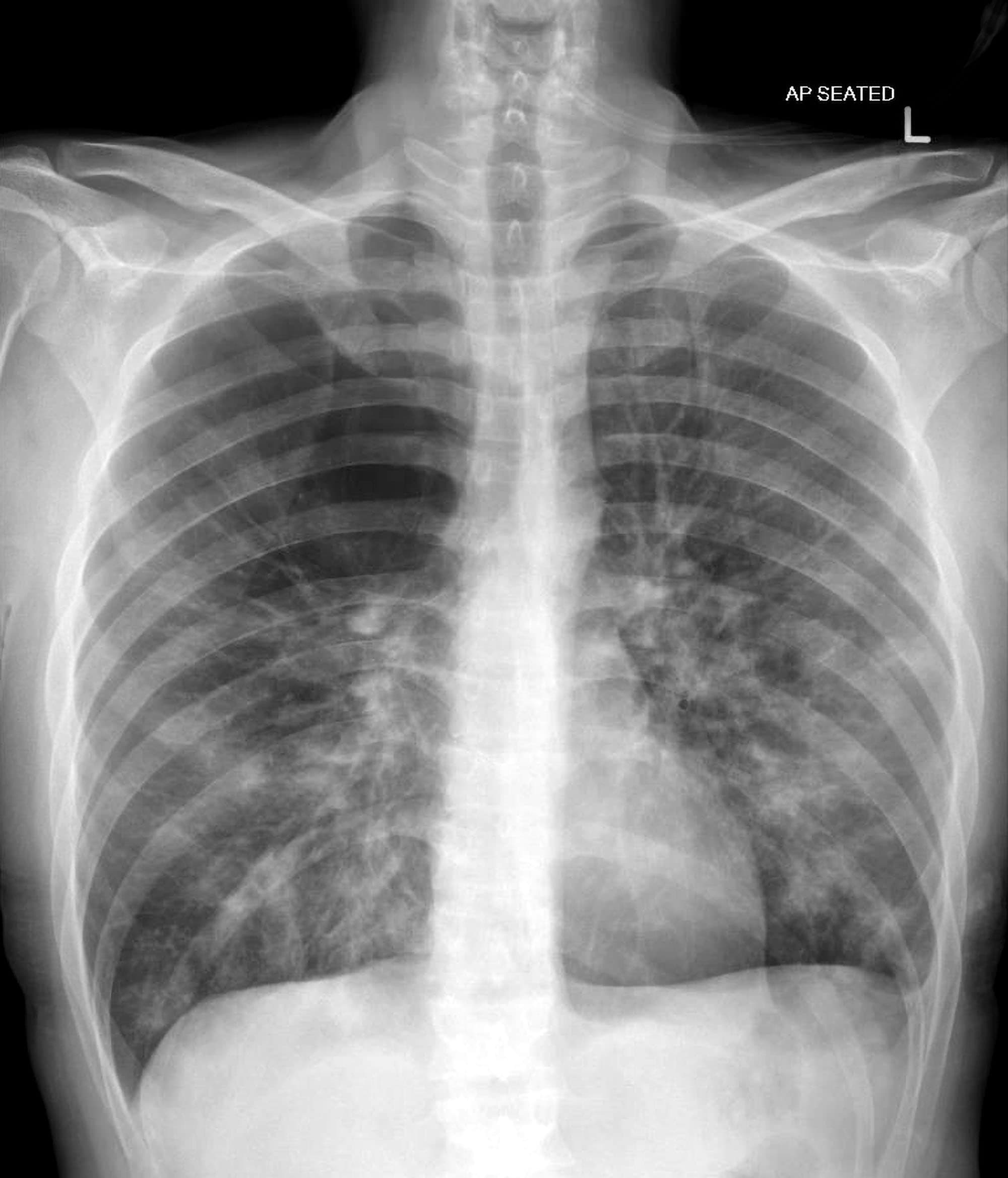 hyperinflation chest x ray