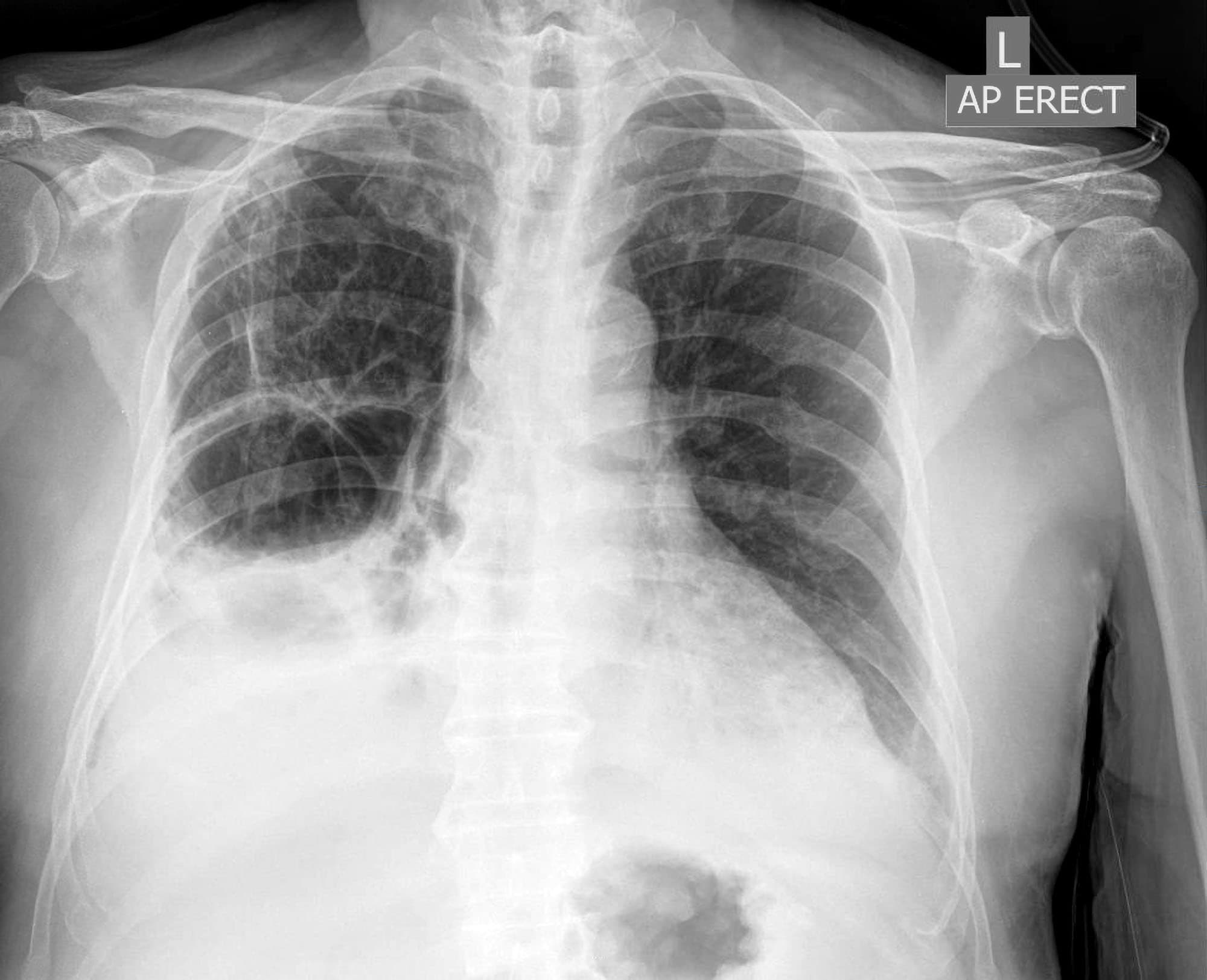 Loss Of Lung Markings Chest X Ray MedSchool