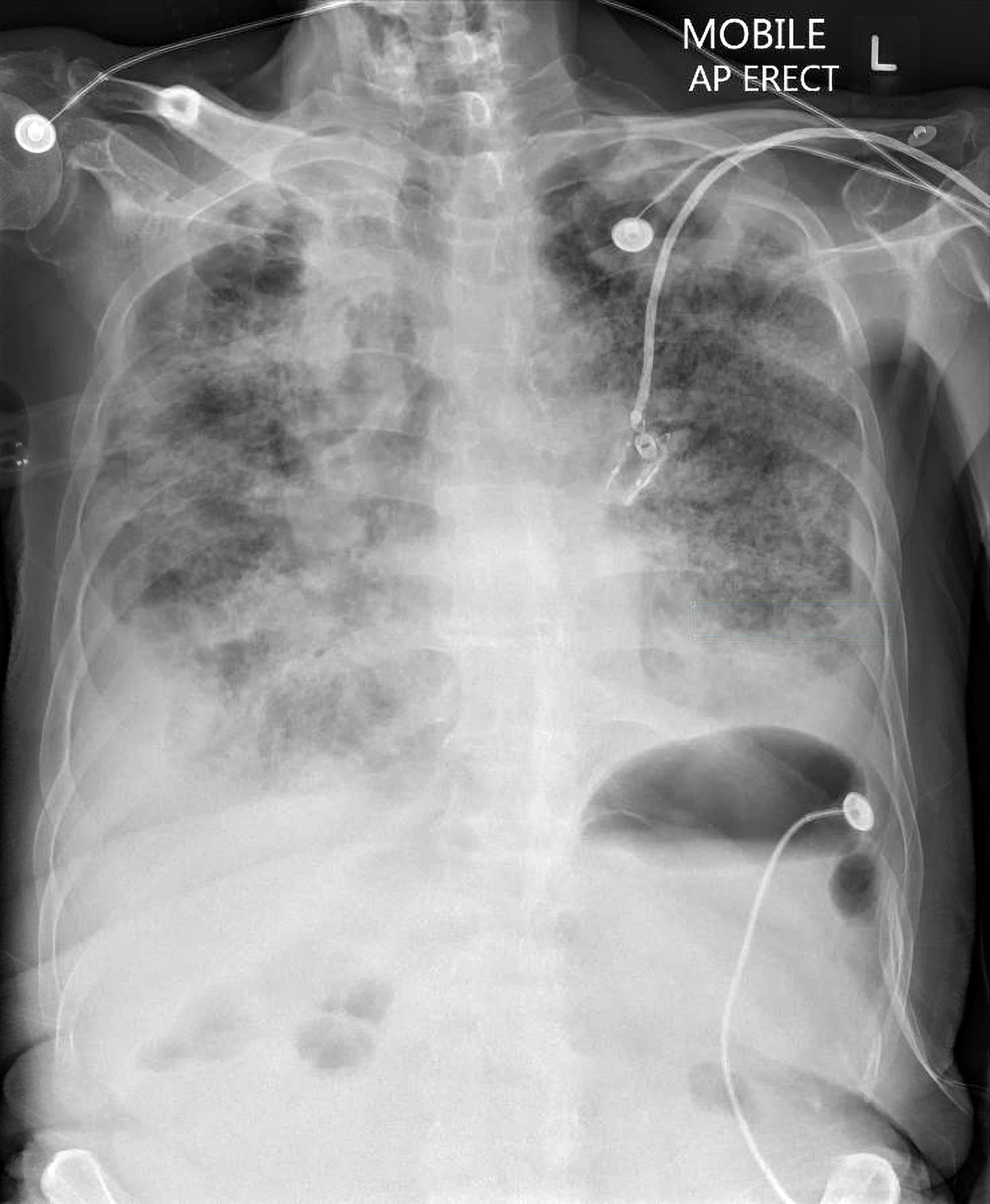 pulmonary-nodules-and-masses-chest-x-ray-medschool