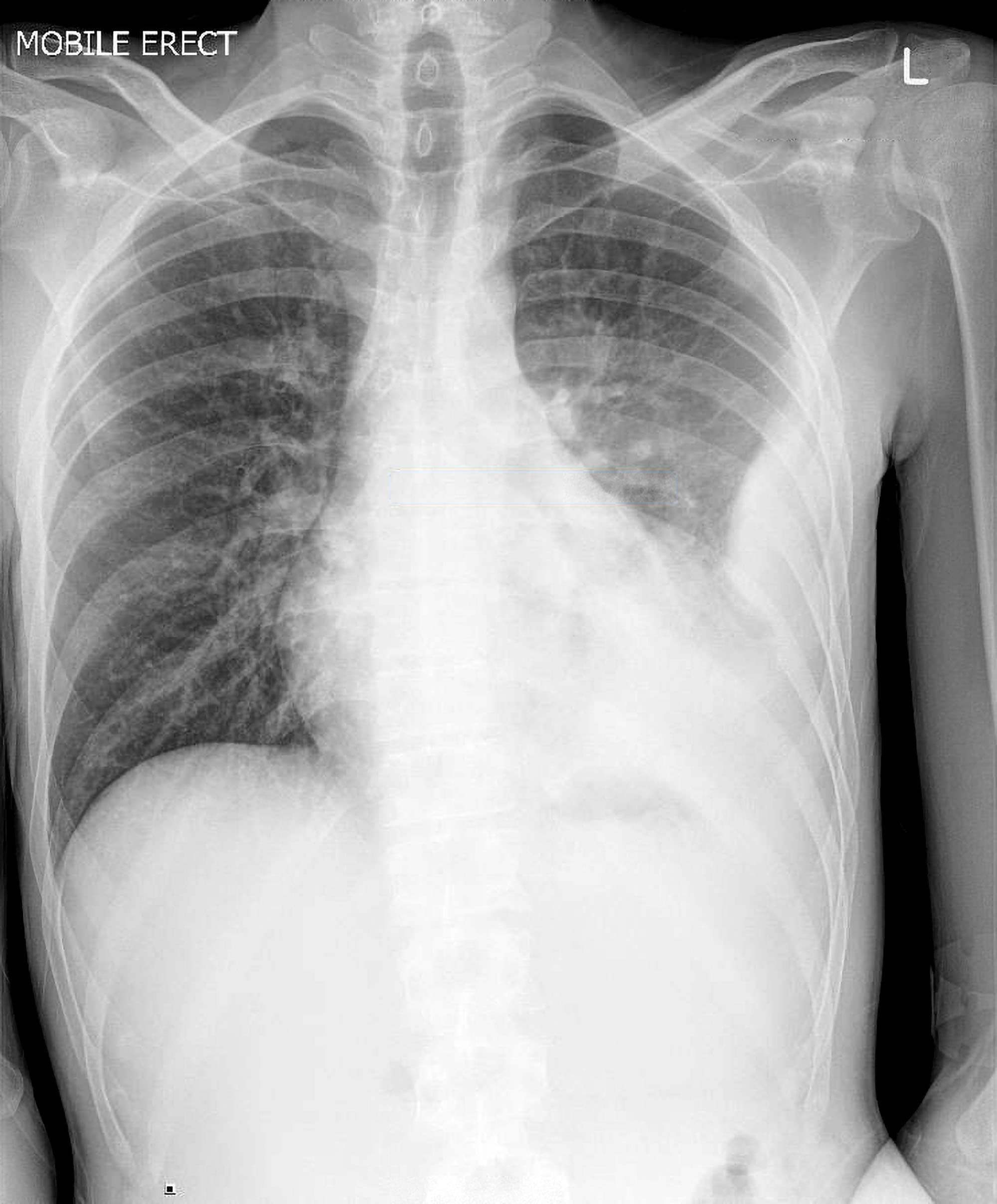 pneumonia chest x ray findings