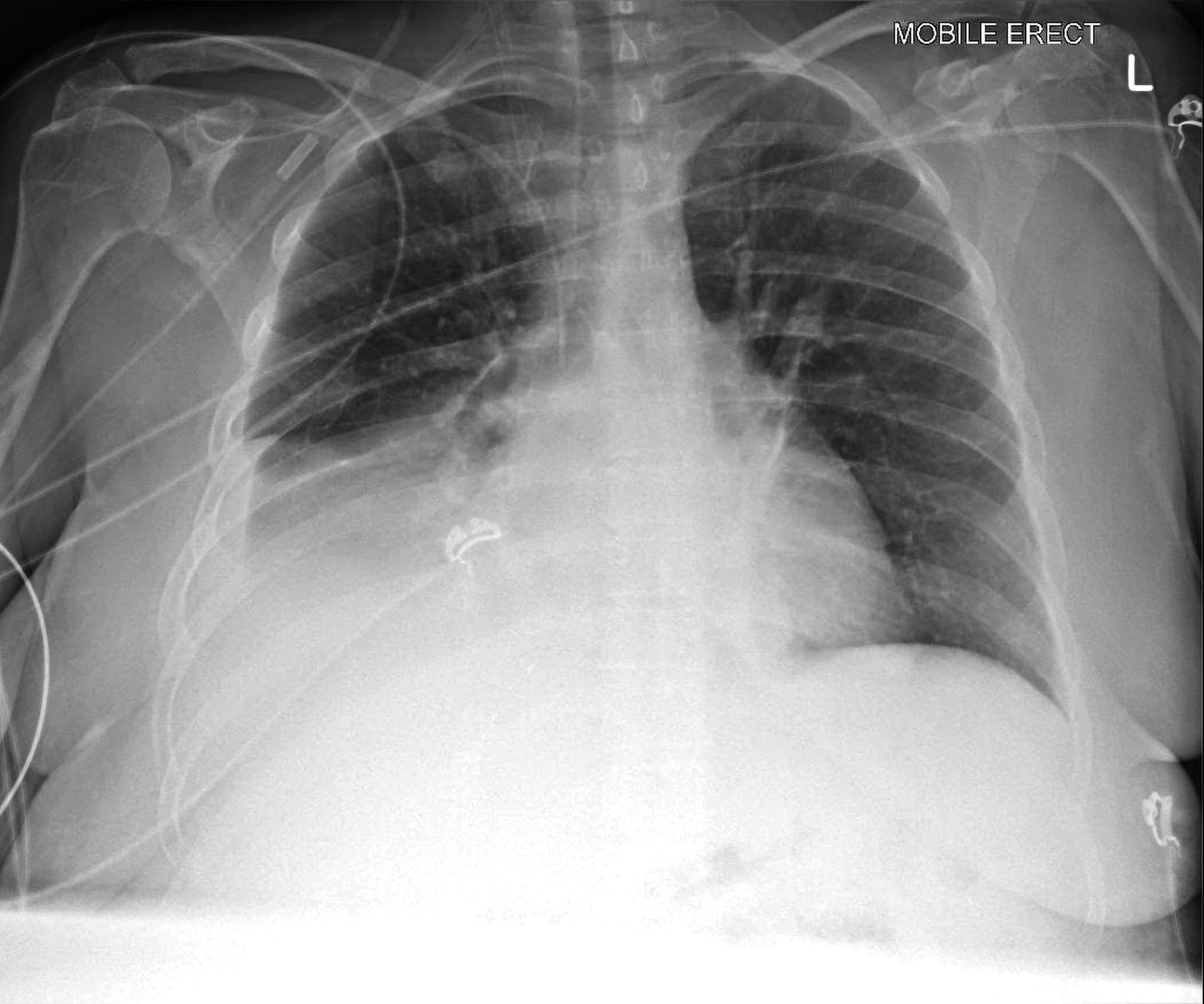 lobar pneumonia chest xray