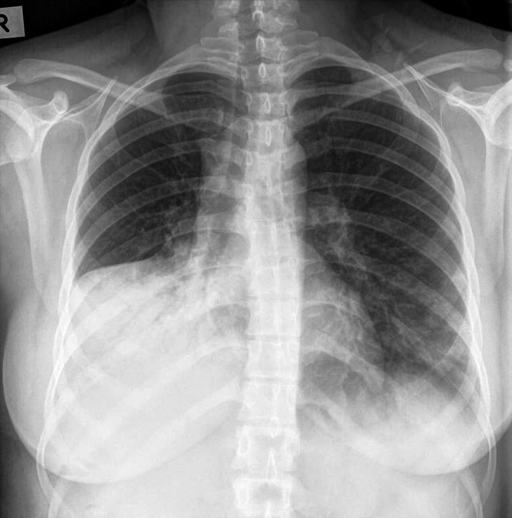 chest xray normal vs abnormal