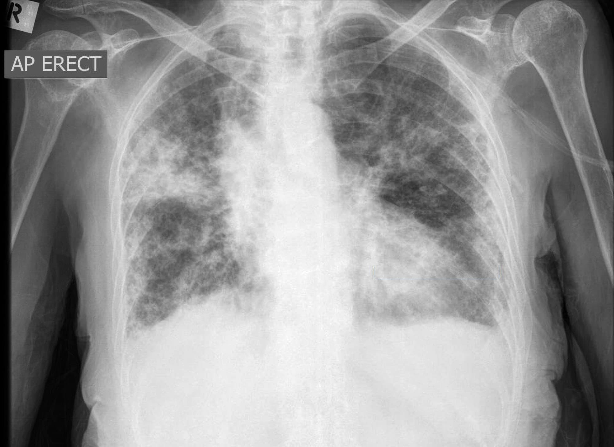 Pulmonary Consolidation | Chest X-Ray - MedSchool