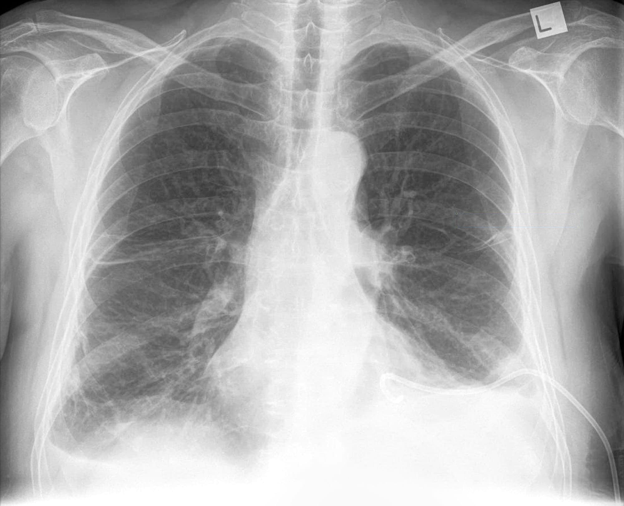 chest tube x ray