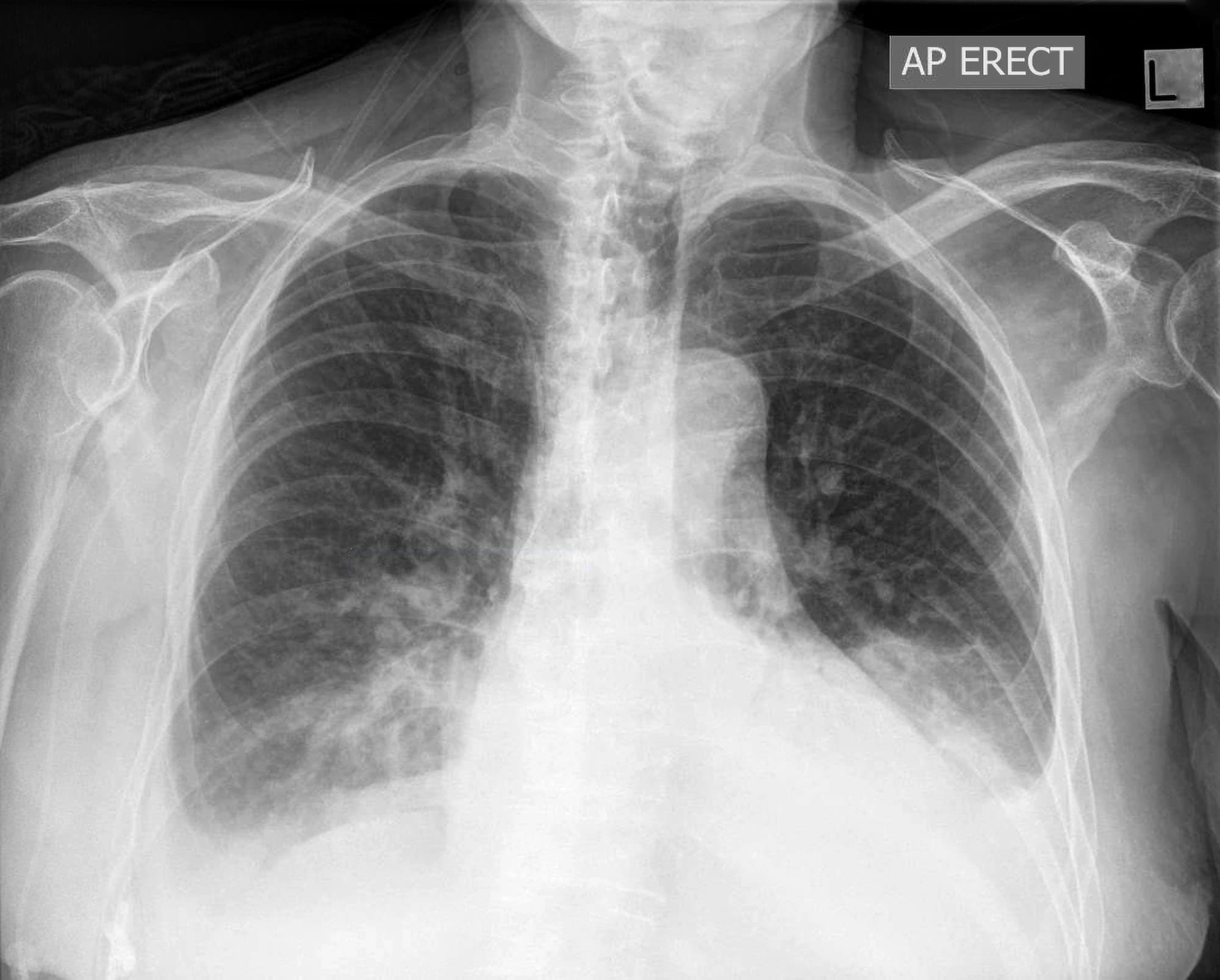 pleural effusion chest x ray