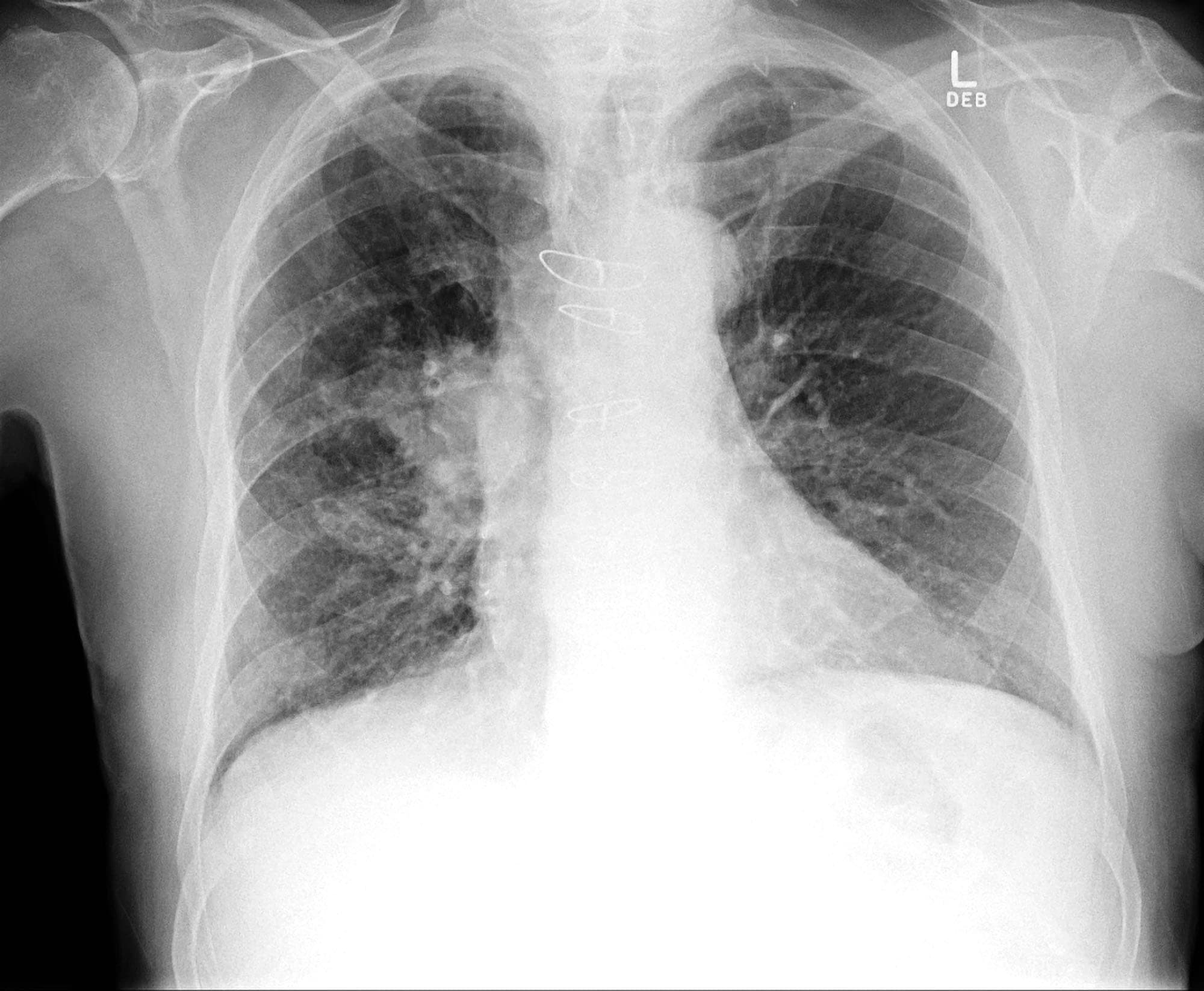 Pulmonary Nodules And Masses Chest X Ray Medschool