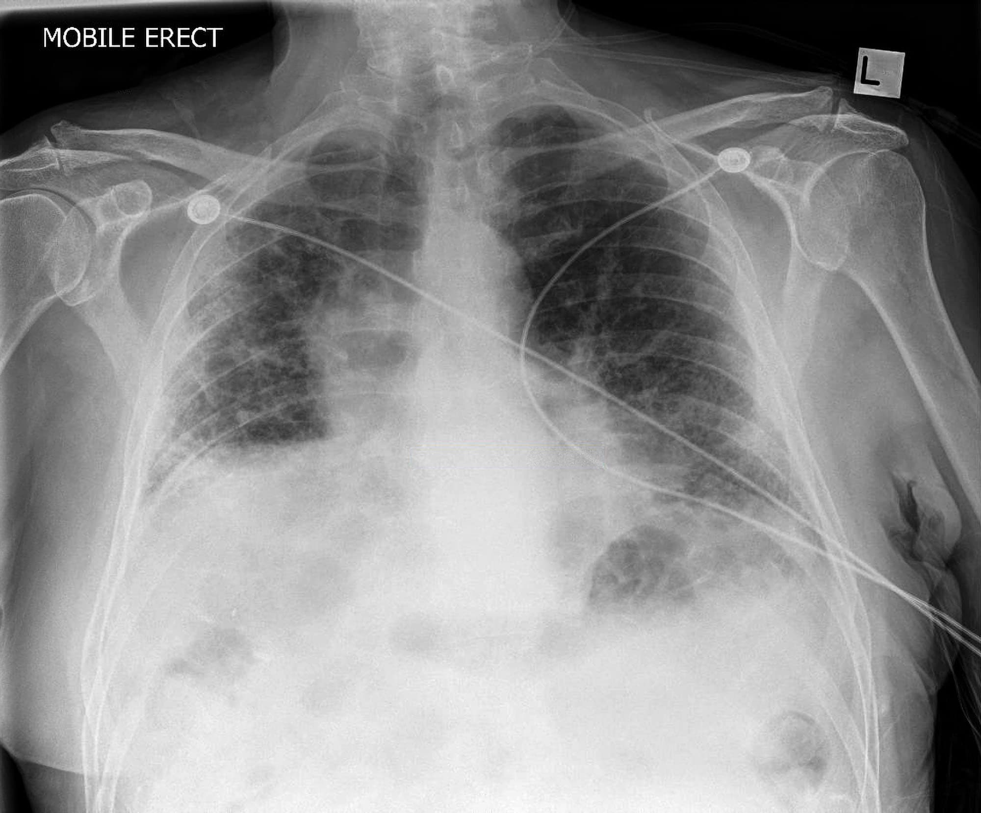 interstitial pneumonia x ray