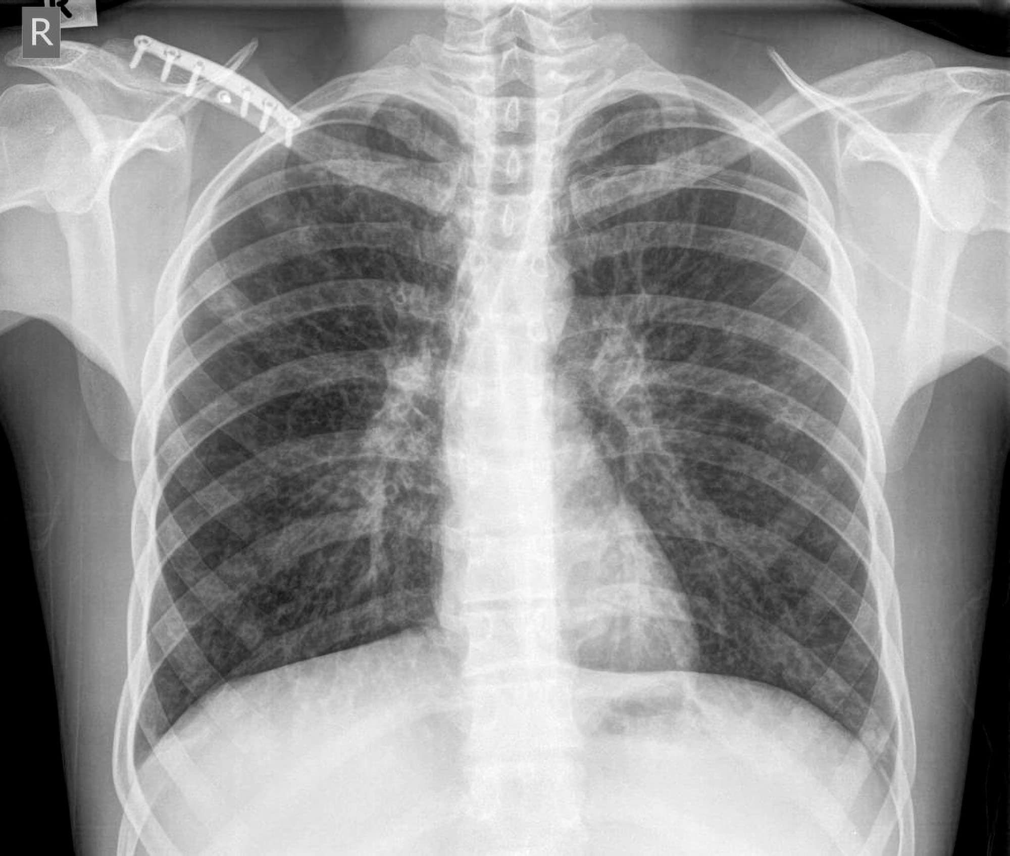 Pa And Lateral Chest X Ray Hot Sex Picture