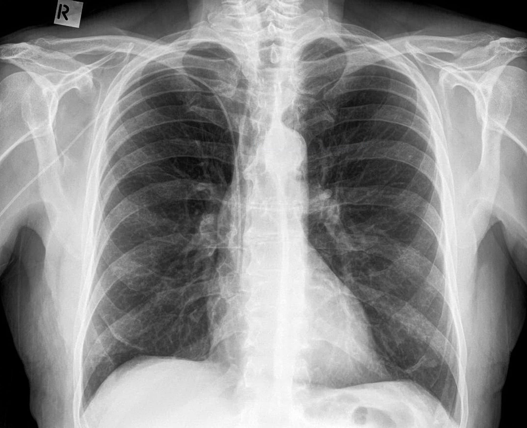 Picc Chest X Ray