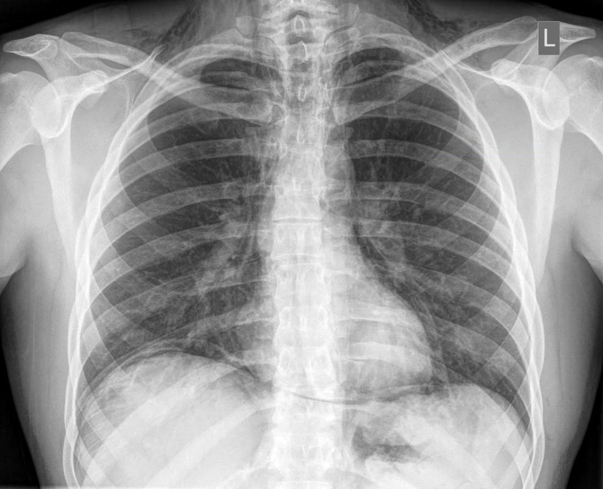 Mediastinal Borders | Chest X-Ray - MedSchool