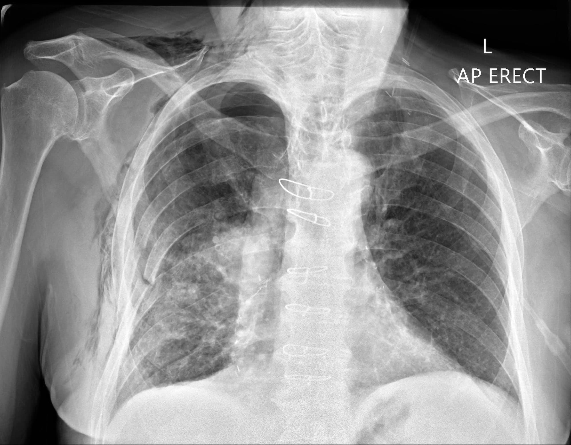 pneumothorax x ray
