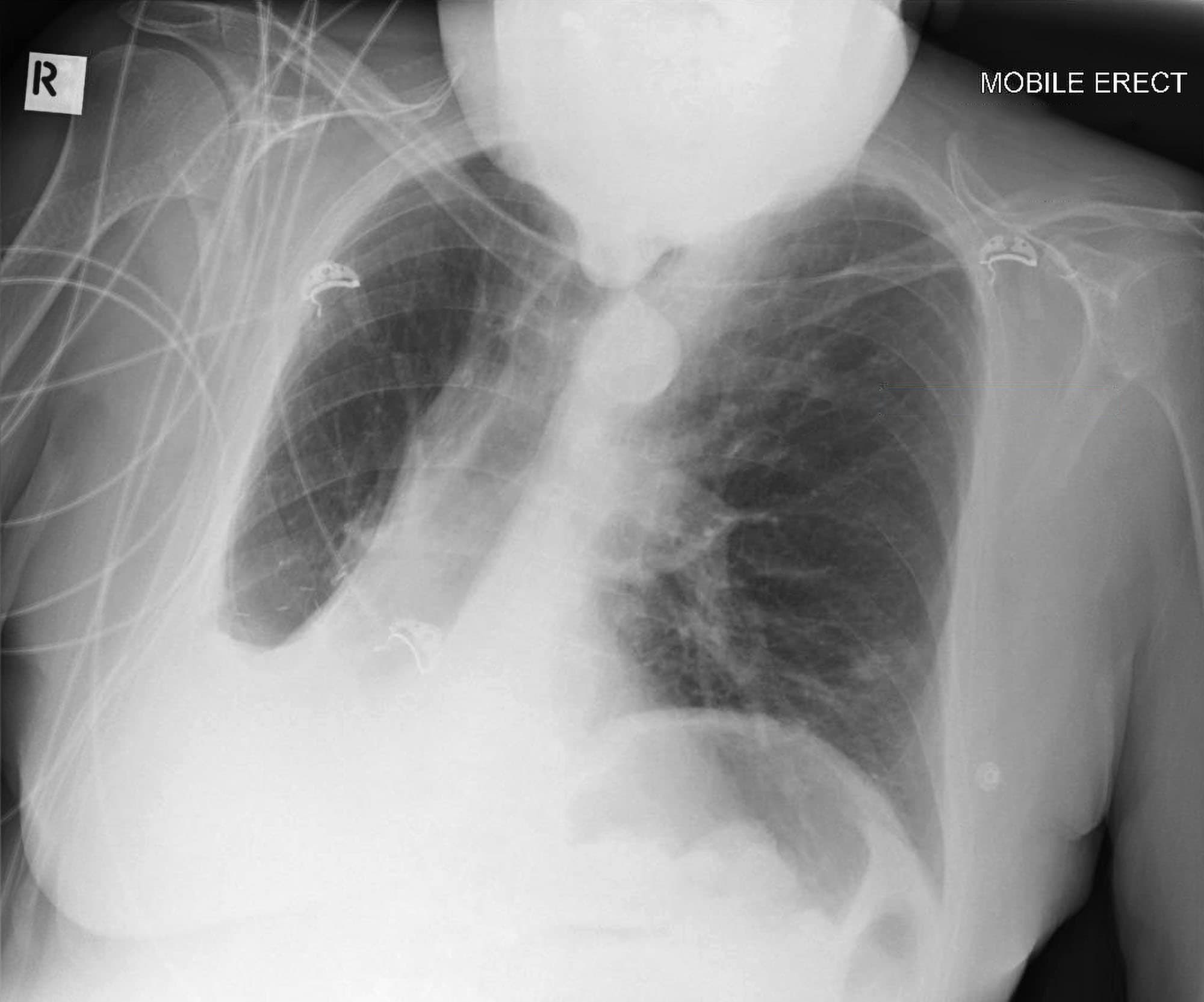 A rotated film with the patient's head obscuring the apices.