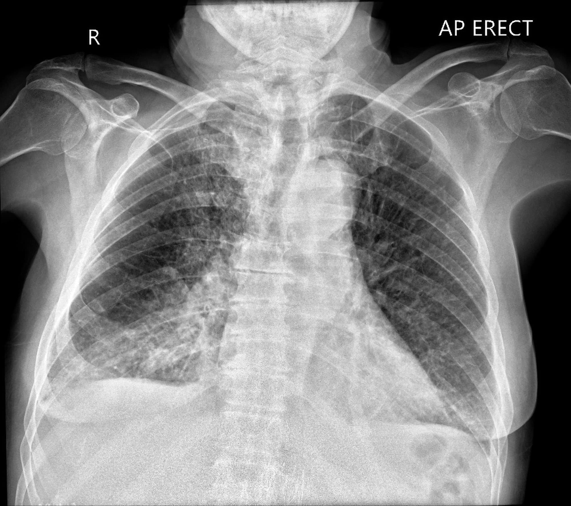 Pulmonary Oedema Chest X Ray MedSchool