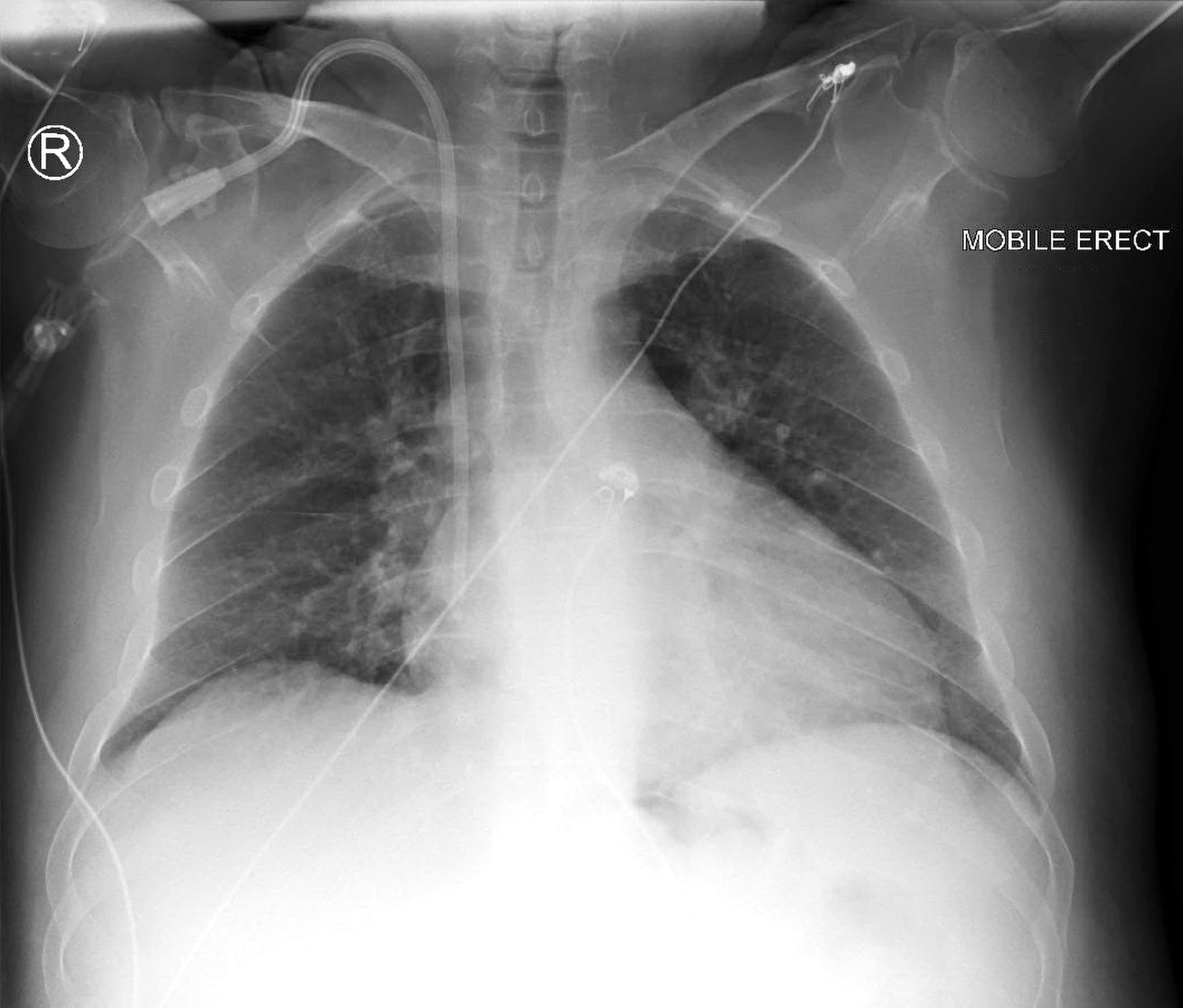 hickman catheter x ray