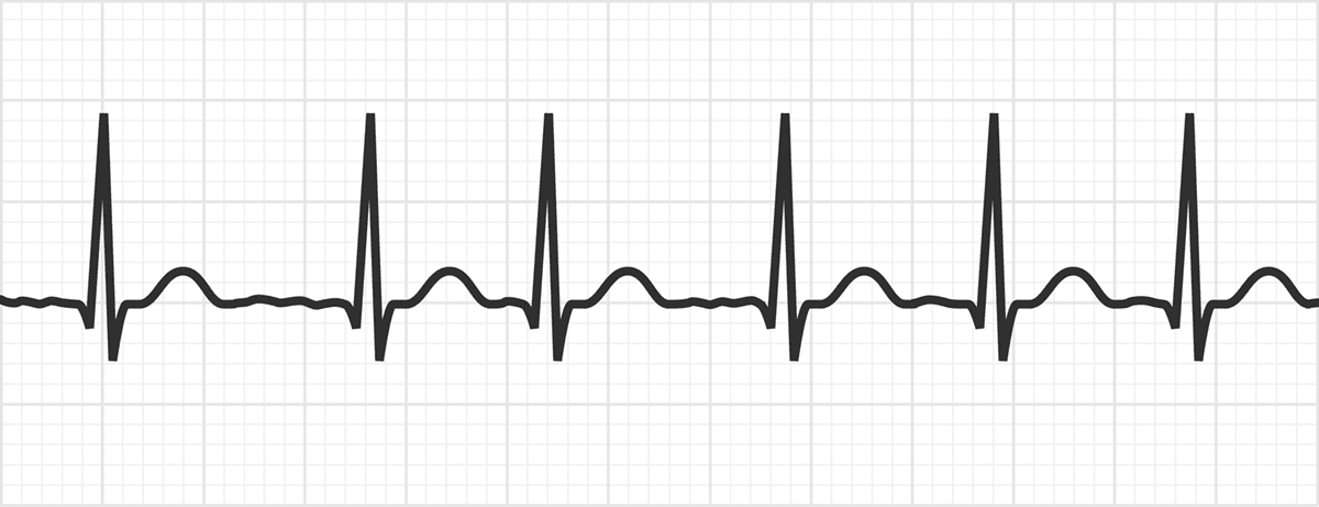 The P Wave / ECG Interpretation - MedSchool