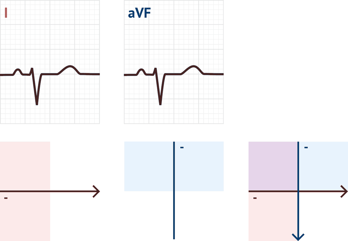 How To Determine Ecg Axis