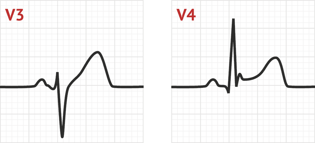 st segment elevation ecg