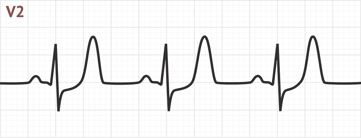 Acute Myocardial Infarction on ECG | ECG Disease Patterns - MedSchool