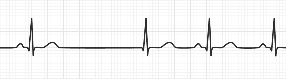 junctional escape rhythm with heart rate under 50 beats