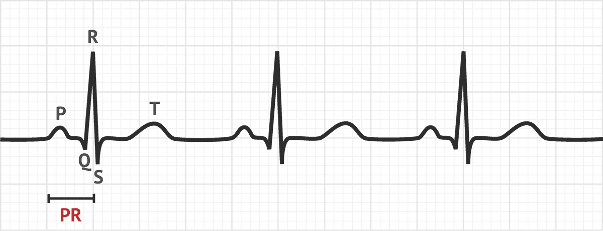 The PR Interval | ECG Basics - MedSchool