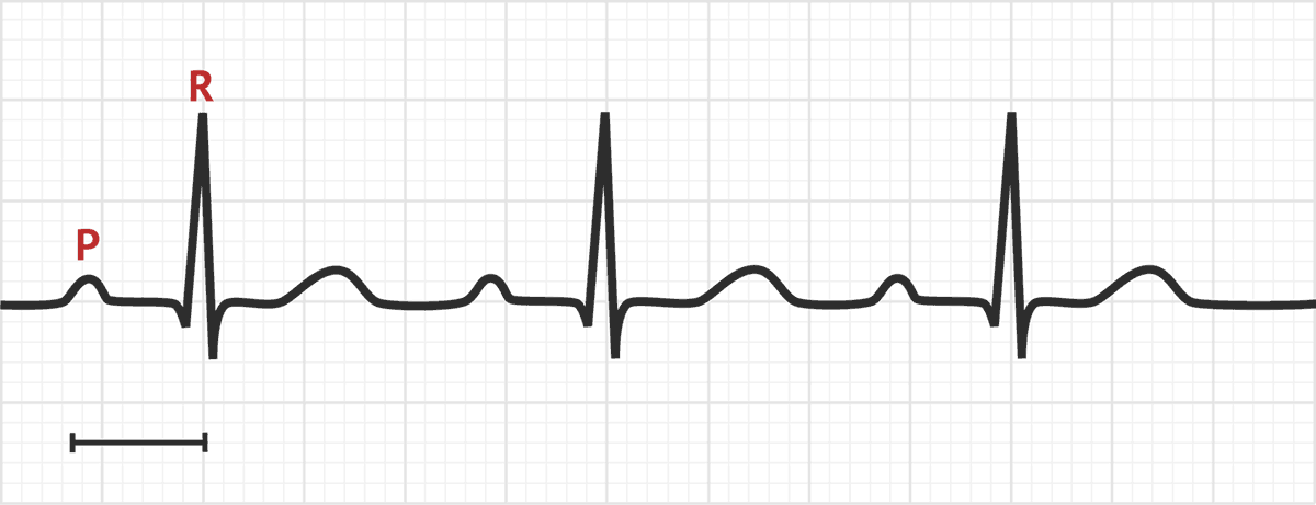 Prolonged Pr Interval Test Findings Medschool