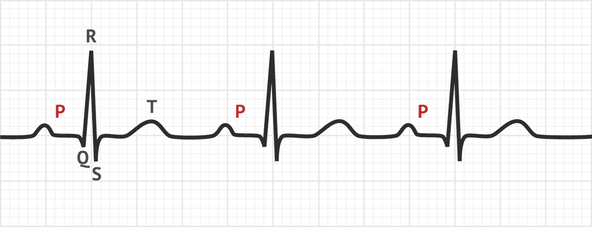 The P Wave ECG Basics MedSchool   Pwave 