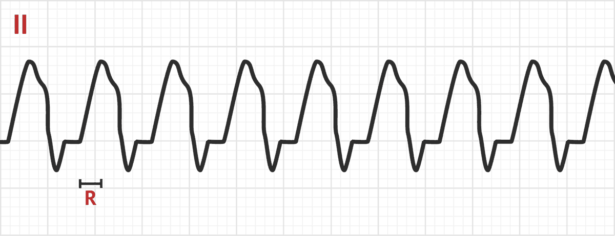 R Wave Peak Time in Lead II