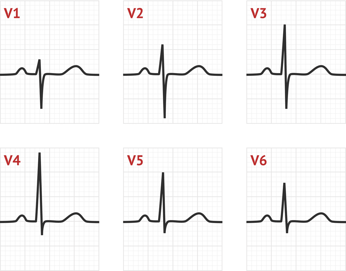 poor-r-wave-progression-tests-medschool