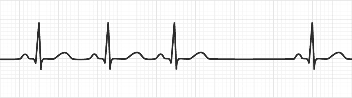 Second Degree SA Exit Block: Type I | Conduction Disorders - MedSchool