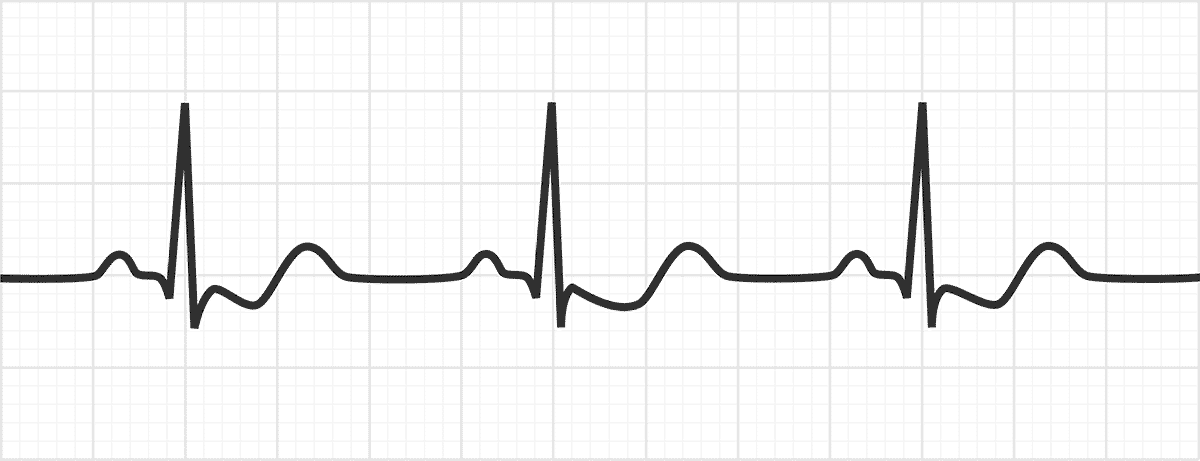 Downsloping ST depression