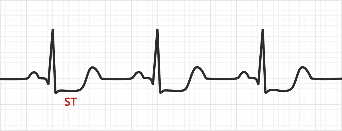 ST Depression | Test Findings - MedSchool