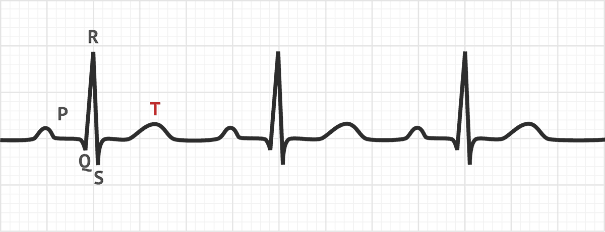 what does a t wave inversion look like