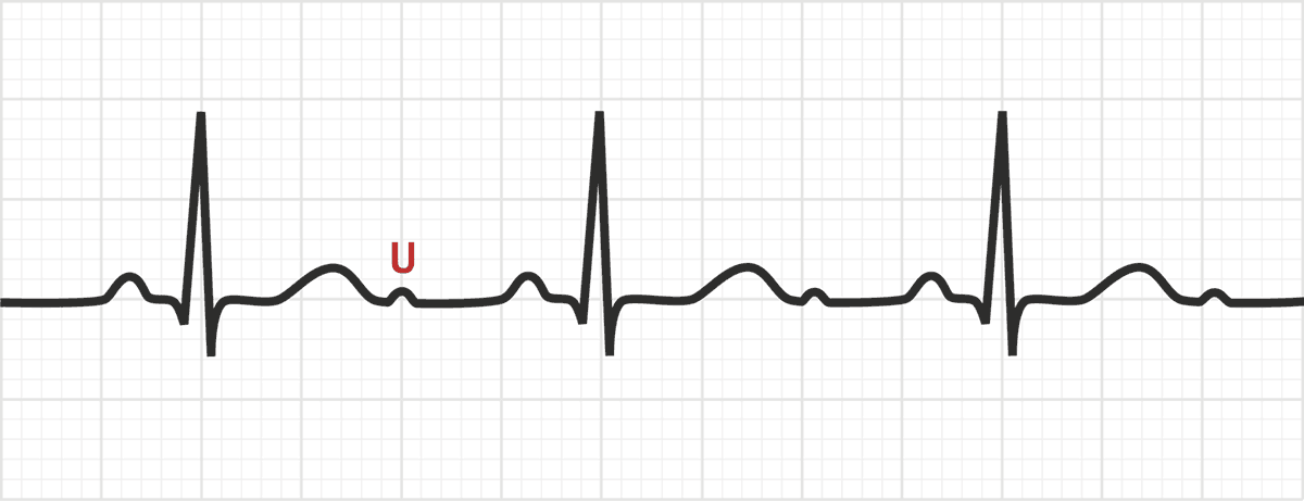 The U Wave ECG Basics MedSchool The U Wave ECG Basics MedSchool
