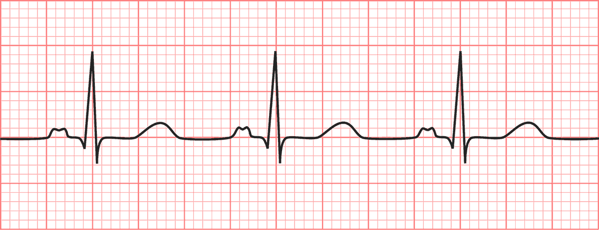 P Mitrale ECG Interpretation: Characteristics Of The Normal ECG