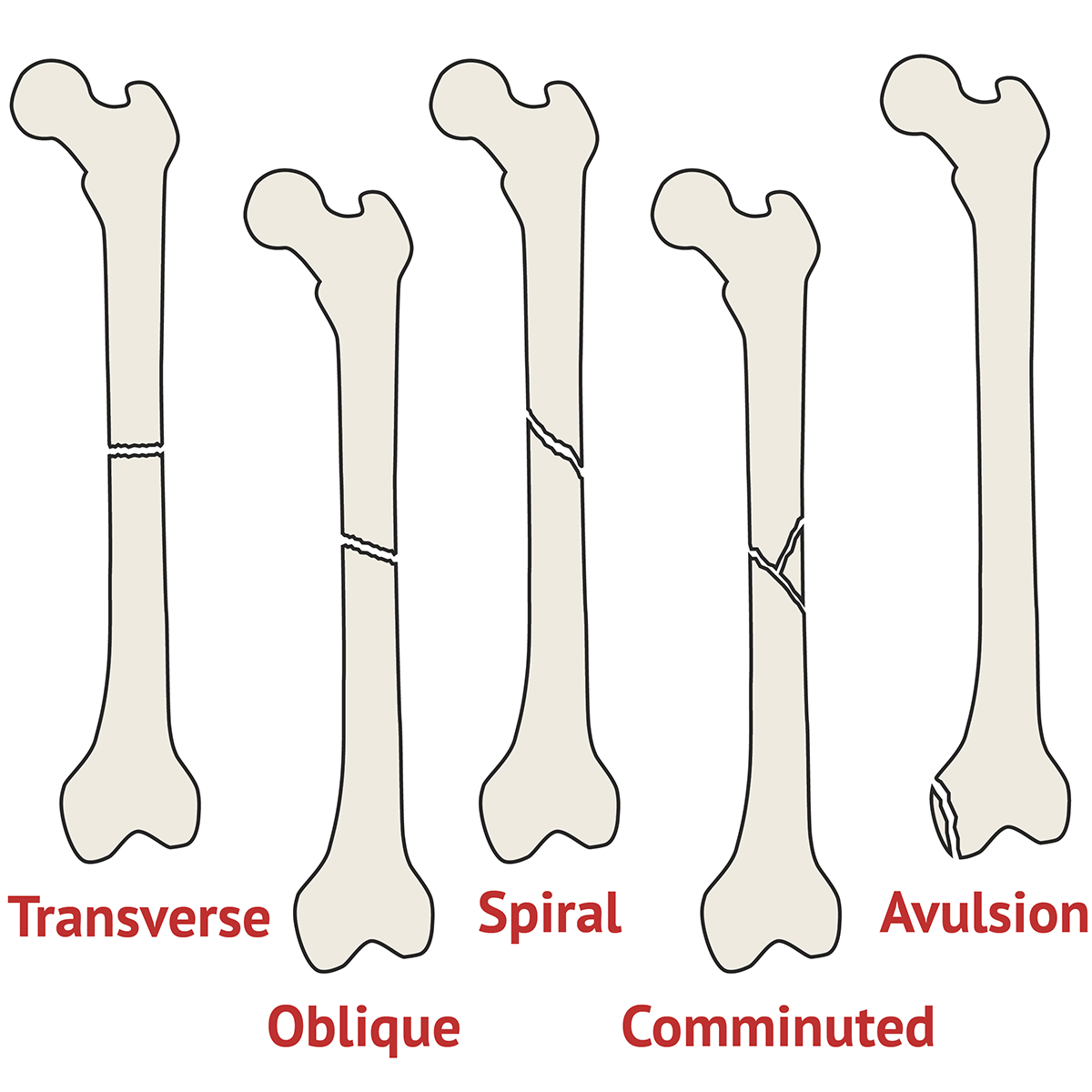 Types of Fracture Ortho XRay MedSchool