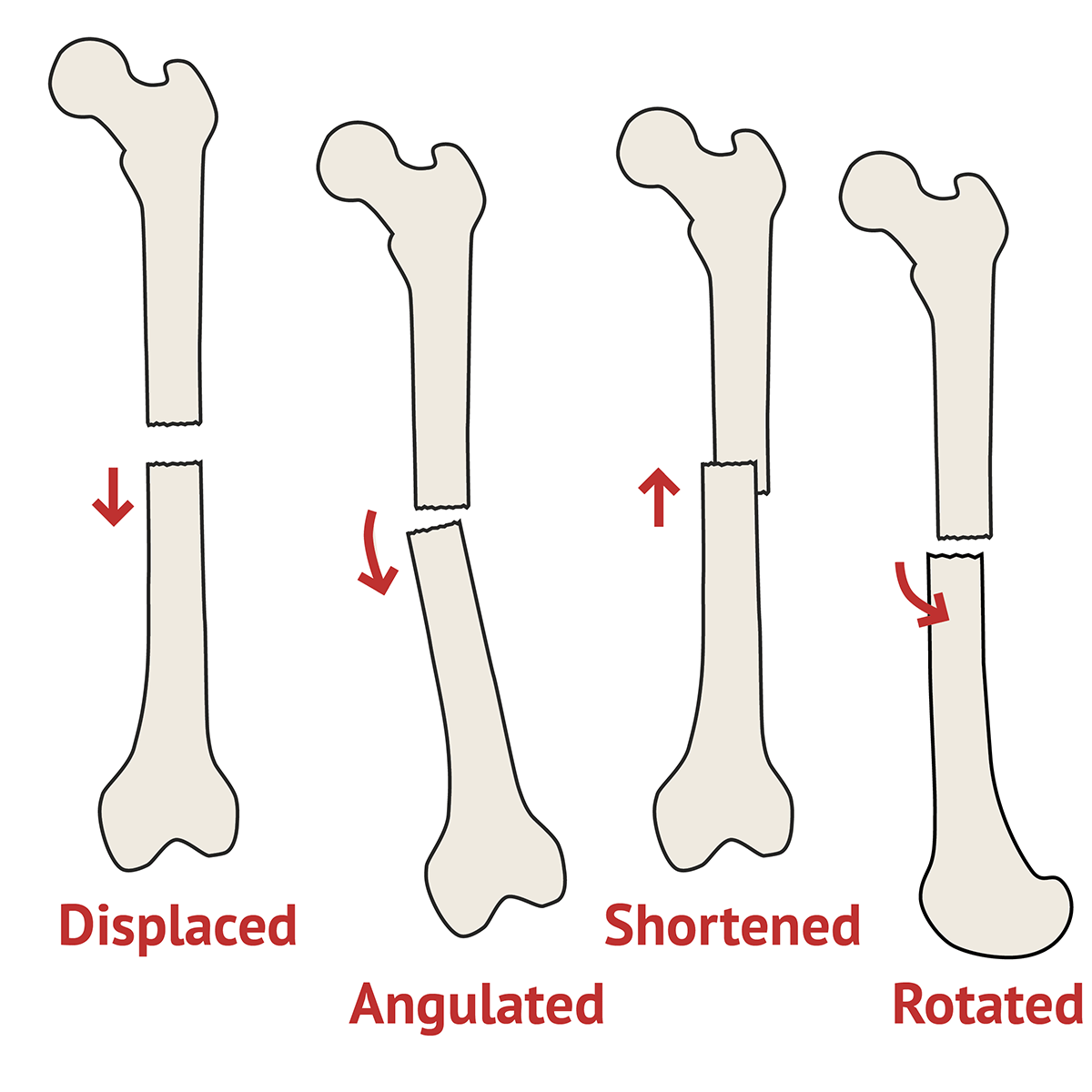 Deformity of Fracture | Ortho X-Ray - MedSchool