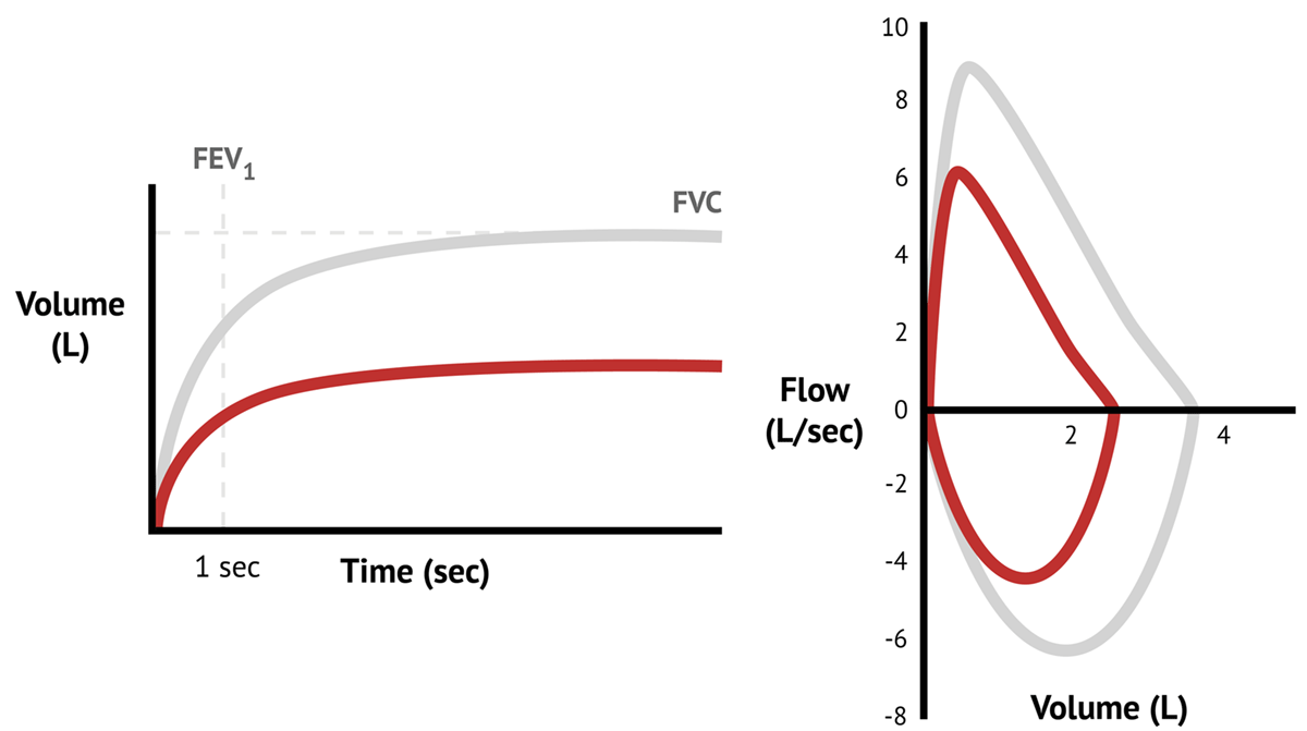 Obstructive vs Restrictive Disease Lung Function Tests MedSchool